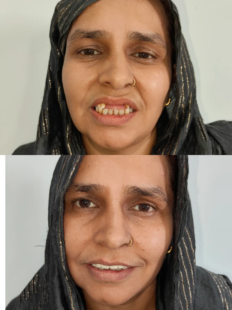Complete Anterior Smile Makeover Before and After