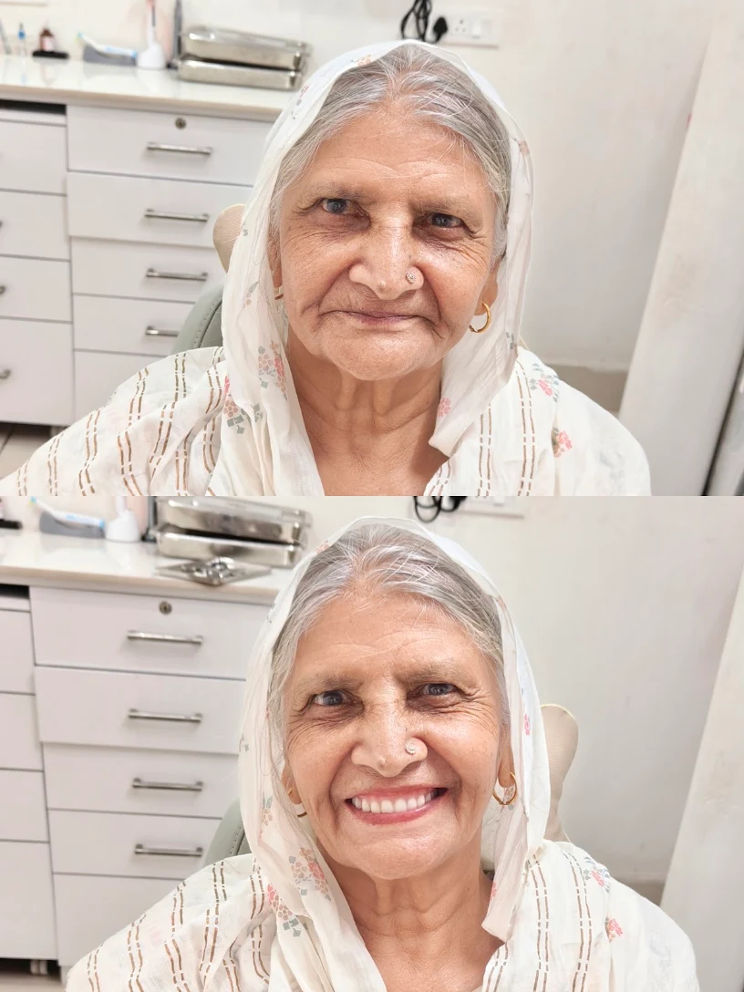 Custom Geriatric Dentures Before and After