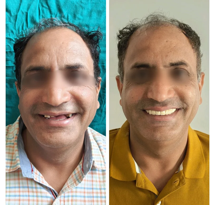 Fixed Anterior Teeth Replacement Before and After