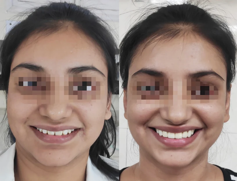 Clear Aligners & Aesthetic Alignment Before and After