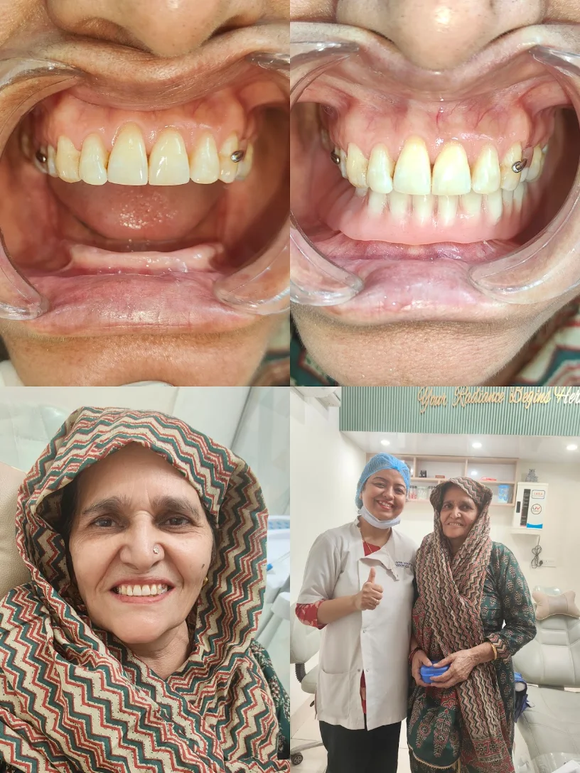 Full Arch Smile Rehabilitation Before and After