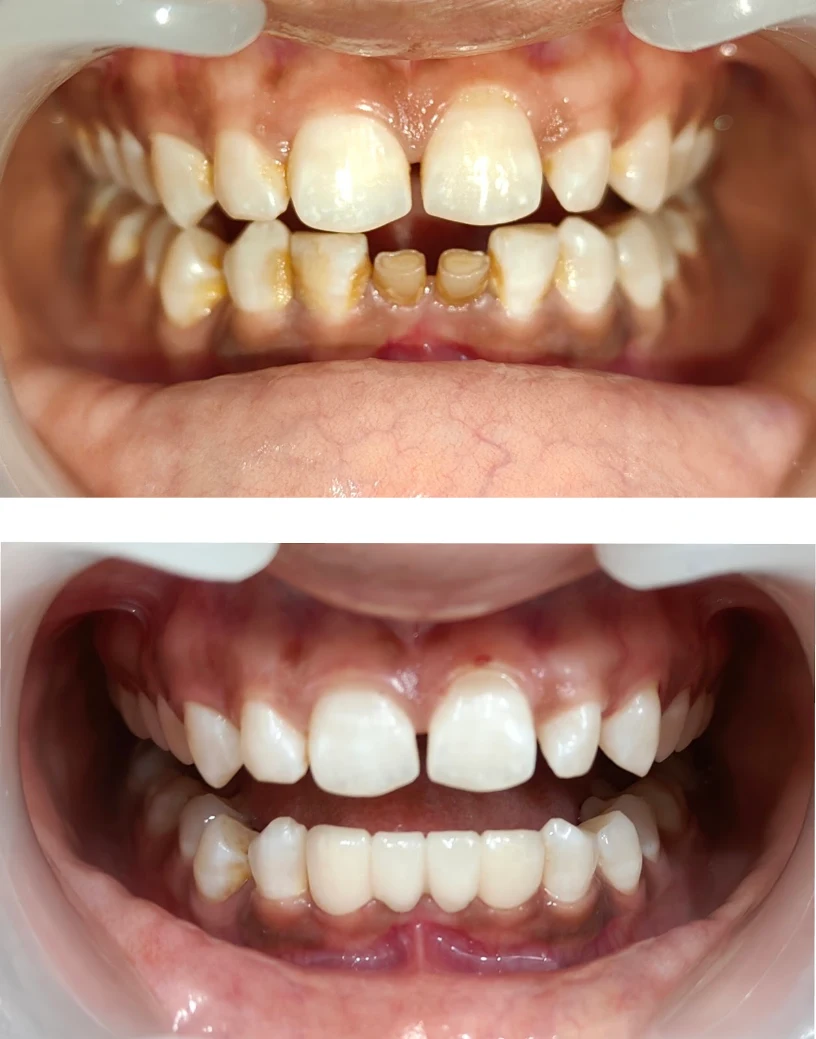 Aesthetic Enamel Veneers & Bonding Before and After