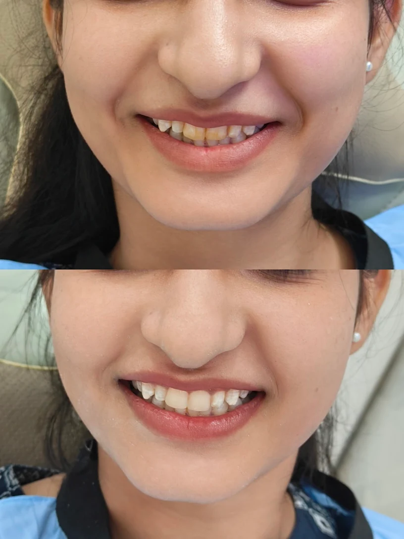 In-Clinic Laser Teeth Whitening Before and After